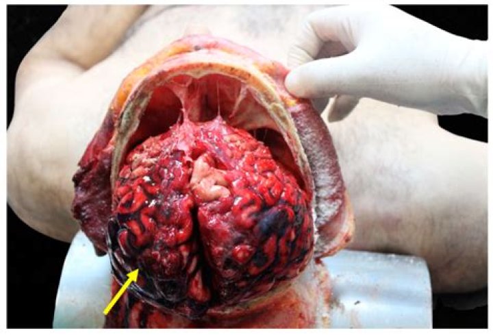 Unraveling The Mystery Of Tarrare's Autopsy Organs